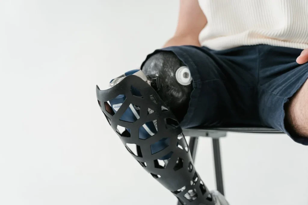 Prosthetics for partial foot and hemipelvectomy amputations serve different purposes based on the level of limb loss. While both help restore function and mobility, they are designed differently to address the unique challenges of each condition.