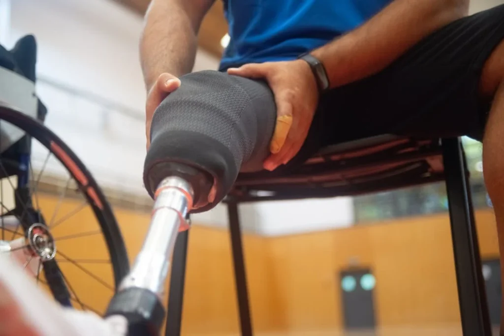 While many patients move steadily through recovery after amputation, others face unexpected delays. It’s important to understand that setbacks do not mean failure — they’re part of the healing journey. However, knowing what complications might slow down prosthetic fitting can help patients stay informed, take precautions, and seek timely help.